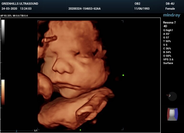 us obstetric dating scan