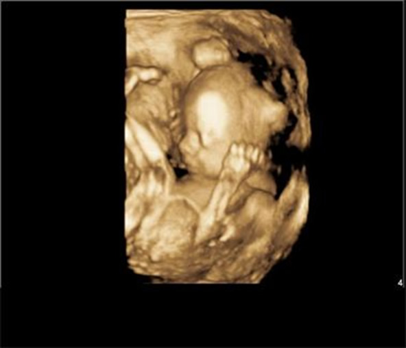 3D and 4D Obstetric Imaging