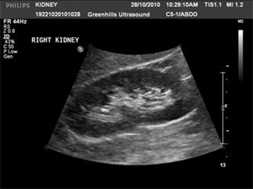 ultrasound right kidney