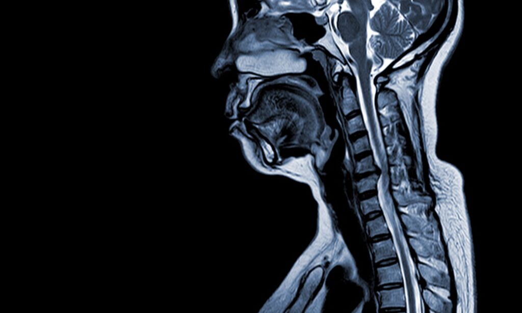 Magnetic Resonance Imaging head neck