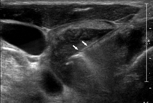Fine needle aspiration biopsy of the thyroid. At GXU radiology we provide FNA for patients across Newcastle, Maitland and further afield.