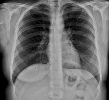 X-RAY CHEST