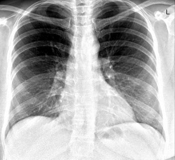 X-RAY CHEST