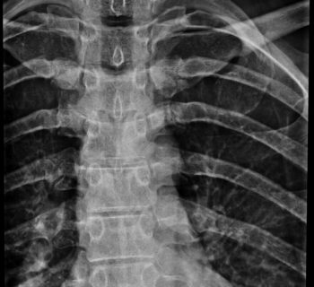 X-RAY SPINE