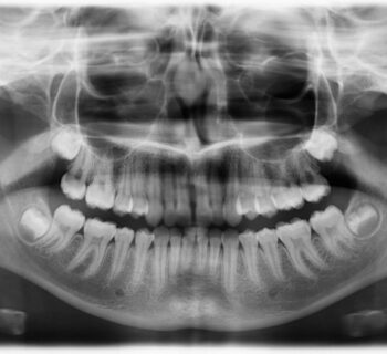 Dental X-ray & OPG